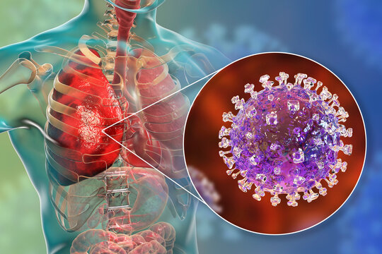 Nipah virus in lungs