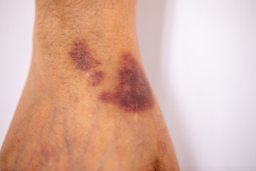 The physical appearance of the arm with the wound is caused by Haemophilia, (Haemophiliais a mostly...