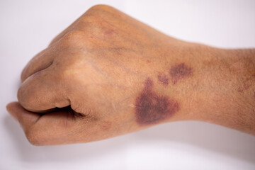 The physical appearance of the arm with the wound is caused by Haemophilia, (Haemophiliais a mostly...