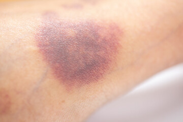 The physical appearance of the arm with the wound is caused by Haemophilia, (Haemophiliais a mostly...