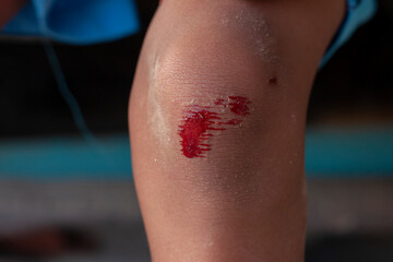 Wounds on the knee of a child due to an accident from playing.