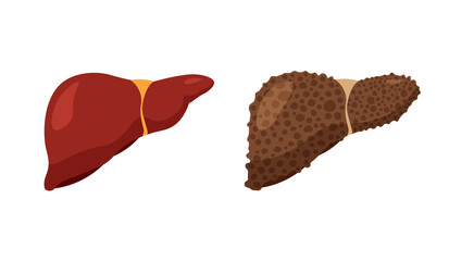 Fatty livers disease. Unhealthy sick liver and strong healthy liver. Digestive system anatomy. Fibrosis and cirrhosis. Vector illustration isolated on white background.