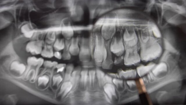 Looking at Panoramic Dental X-Ray Image through Magnifying Glass POV