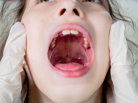 pediatrician doctor in medical gloves examines the child's sore throat with herpes sore throat