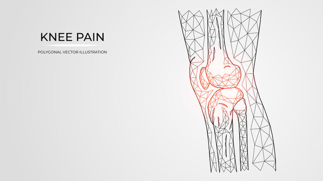 Polygonal vector illustration of pain, inflammation or injury in the knee side view. Human leg bones anatomy. Medical orthopedic diseases templates.