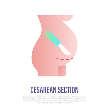 Cesarean section thin line icon. Scalpel near belly. Surgical operation for childbirth. Vector illustration.