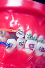 Dental teeth aligners brackets