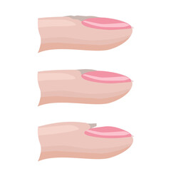 The structure of the nail, types of nail cuticle. Hand nail care. Vector illustration