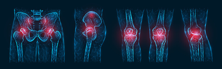 Polygonal vector illustration of pain or inflammation of the bones in the pelvis, hip joint, and knee joints isolated on a dark blue background. Orthopedic diseases medical template. - obrazy, fototapety, plakaty