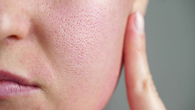 Skin texture with enlarged pores. Part of a woman's face close-up. Irritation, allergies, problem skin. Concept skincare. Beauty face.