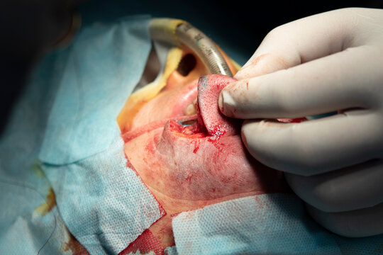 Lip vascular tumor reduction surgery close-up while surgeon holds the lip before sewing