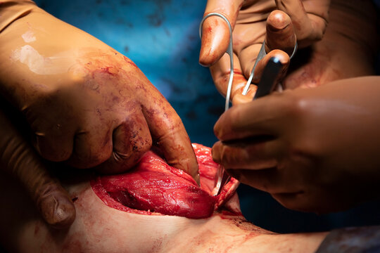 Leg surgery close-up with open wound and surgeon hands and muscle tissues