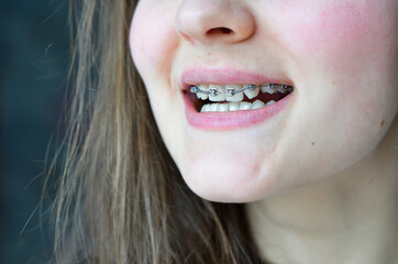 The girl is smiling, braces are installed