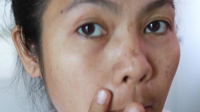 Asian women have facial skin problems, wrinkles, blemishes, dark spots, freckles