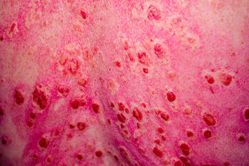 Discoid rash of system lupus erythematosus on the back 