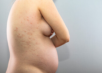 Red rash on the skin of a pregnant woman. Avitaminosis. 