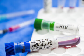 Closeup of HIV POSITIVE test tubes on the table in a laboratory