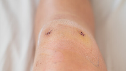 Fototapeta premium Close-up of a surgical suture on the knee after laparoscopic meniscus surgery.