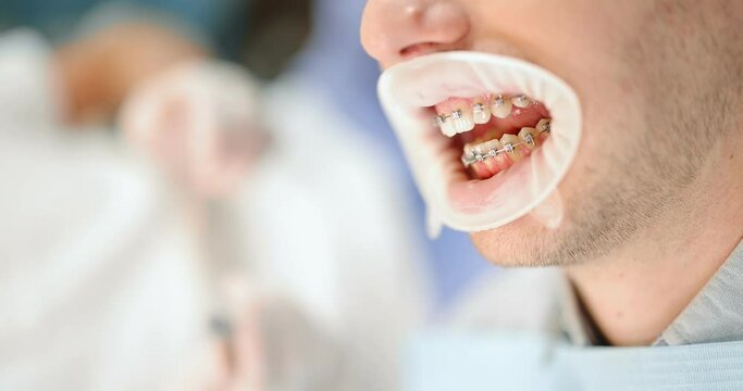 Dentist adjusting dental braces during orthodontic treatment for the young male patient, close-up on patient's mouth. Vertical video