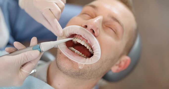 Patient with dental braces during an orthodontic treatment. Close-up on a patient's mouth opened with dental optragate