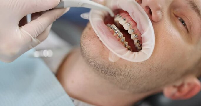 Patient with dental braces during an orthodontic treatment. Close-up on a patient's mouth opened with dental optragate