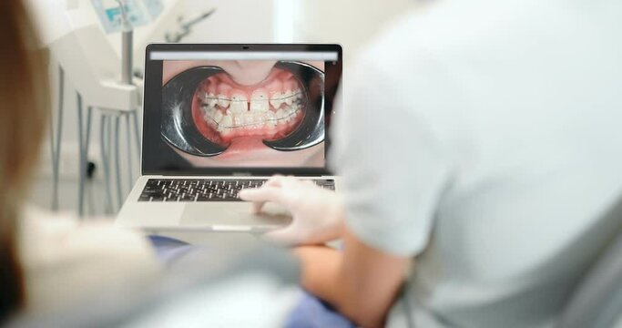 Dentist showing photo of teeth on a laptop for a young patient during an orthodontic treatment. Orthodontic treatment with the help of braces