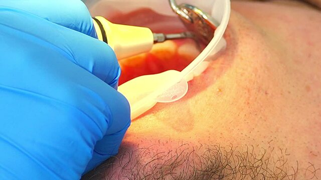 a dentist in a dental clinic places a filling on a sore tooth and pulpitis on a dental nerve, and also cleans teeth from plaque and caries