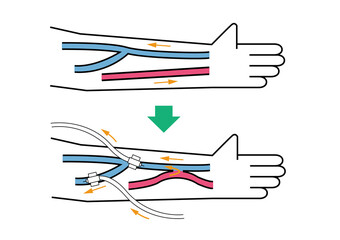 シャント手術,hemodialysis, dialysis shunt