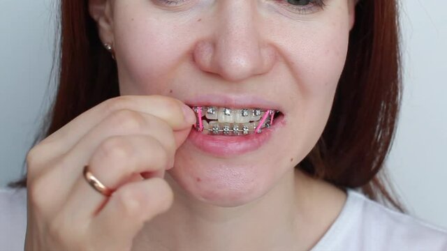 A girl with braces on her teeth puts colored rubber bands on her hands.
Smooth teeth from the installation of braces