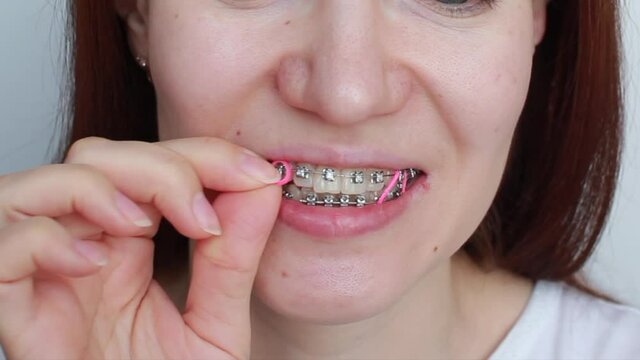 A girl with braces on her teeth puts colored rubber bands on her hands.
Smooth teeth from the installation of braces