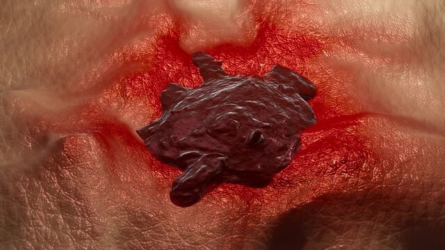 3D animation of a close-up of a growing skin cancer like the malign melanoma inflaming surrounding tissue.
