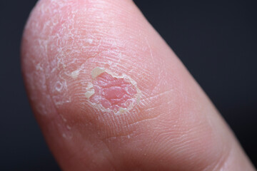 close up of a finger with eczema