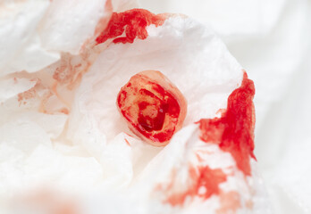 Obraz na płótnie Canvas Close-up of a tooth covered in blood in a napkin.