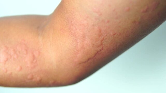 Itchy, allergic reaction, Close up rash with blisters on a man hand