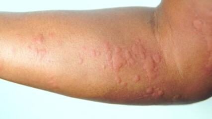 Itchy, allergic reaction, Close up rash with blisters on a man hand