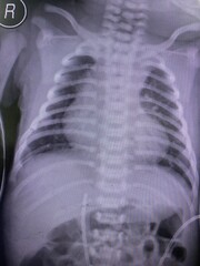 X ray show Boot shape heart is the shape of tetralogy of fallot the congenital heart disease