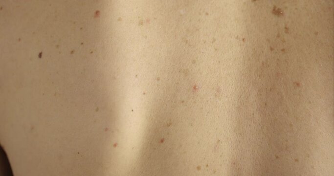 Close-up of large rashes or smallpox on the skin of an adult male. Pigmented spots on the back of a man. Skin of a man with moles. Acne. Problem skin. Skin care