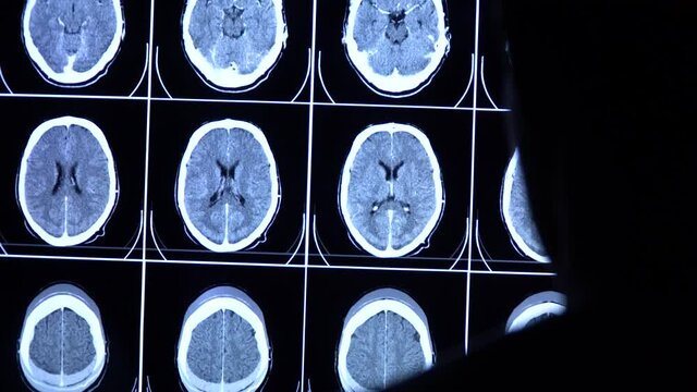 Medical scientist scrolls CT, MRI brain scan images on a big screen. Doctor neurologist checks tomography of a human brain. Radiology diagnostic of neurology diseases. 4k close-up video.