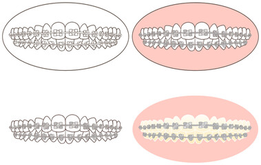 正しい歯並びに矯正治療の為のメタルブラケット装着セット