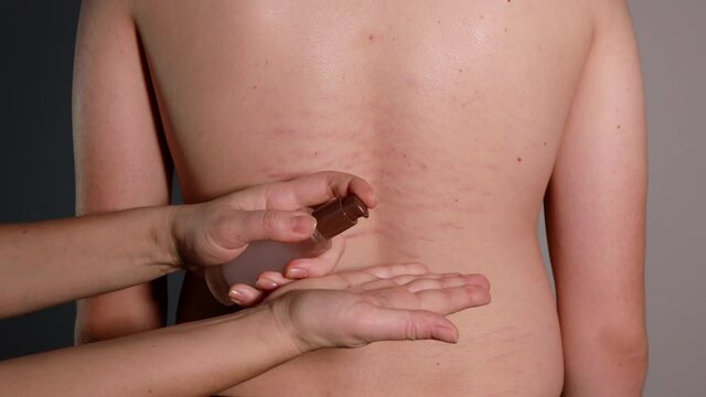 Close up view of the hand applying a drop of transparent gel on the young pearson's back with striae distensae (striae rubrae) background. The concept of impaired skin elasticity during puberty