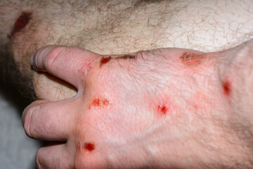 A man's red, bloody, painful leg and hand injury from a fall while sport. Sports injury concept for...