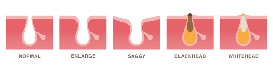 Troublesome pores. Normal, enlarge, saggy, blackhead, whitehead. Pale colored illustration in flat cartoon style.