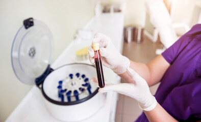 Platelet-Rich plasma preparation. Tube with blood in hands