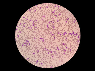 Leukemoid reaction describes an increased white blood cell count, or leukocytosis, which is a...