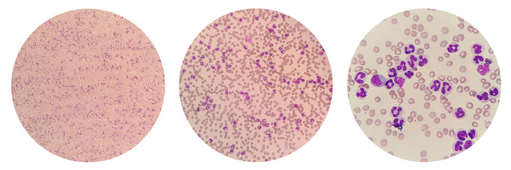 Leukemoid reaction describes an increased white blood cell count, or leukocytosis, which is a physiological response to stress or infection. Canine peripheral blood smear under light microscope.