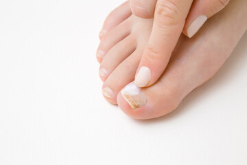 Young adult woman finger using and applying moisturizing cream on toe nail. Dry damaged female toe...