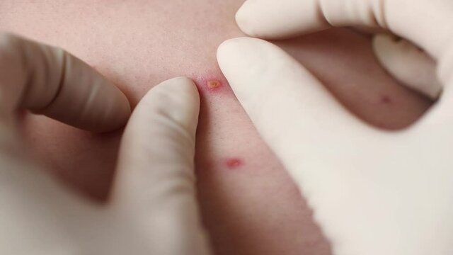 Close-up doctor examines skin full of blisters, scars and rashes caused by varicella chickenpox. A man who having varicella blisters or chickenpox on a back, chicken pox disease.