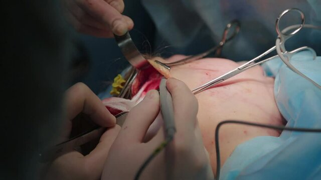 Plastic surgeon performs facelift surgery with a scalpel, tweezers and clamps, close up. High quality FullHD footage