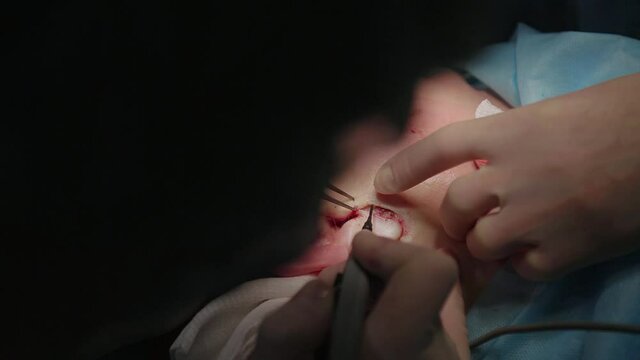 Plastic surgeon performs facelift surgery with a scalpel, tweezers and clamps, close up. High quality FullHD footage