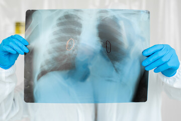 Epidemiologists in respirators examine the patient's pneumonia on a radiograph Covid-19. Concept of...